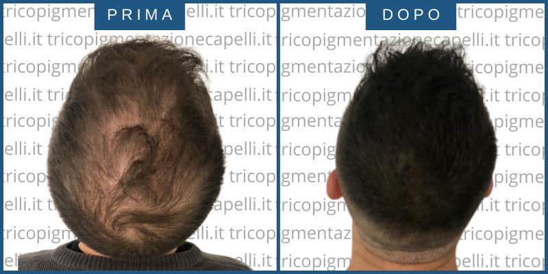 Tricopigmentazione-permanente-effetto-densita-infoltimento-capelli-lunghi-foto-immagini-prima-dopo-padova