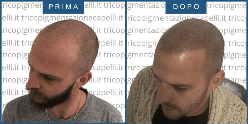 Tricopigmentazione-prima-dopo-effetto-rasato-foto-immagini-padova